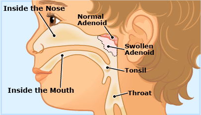 What are adenoids?