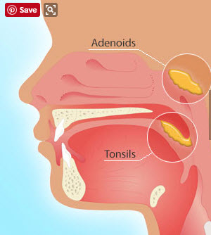 adenotonsillectomy