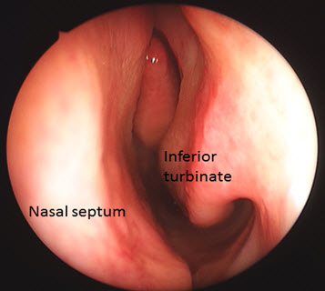 Healthy inferior turbinate