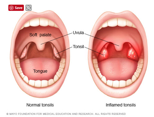 How inflamed tonsils compare with normal tonsils
