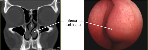 Swollen turbinates